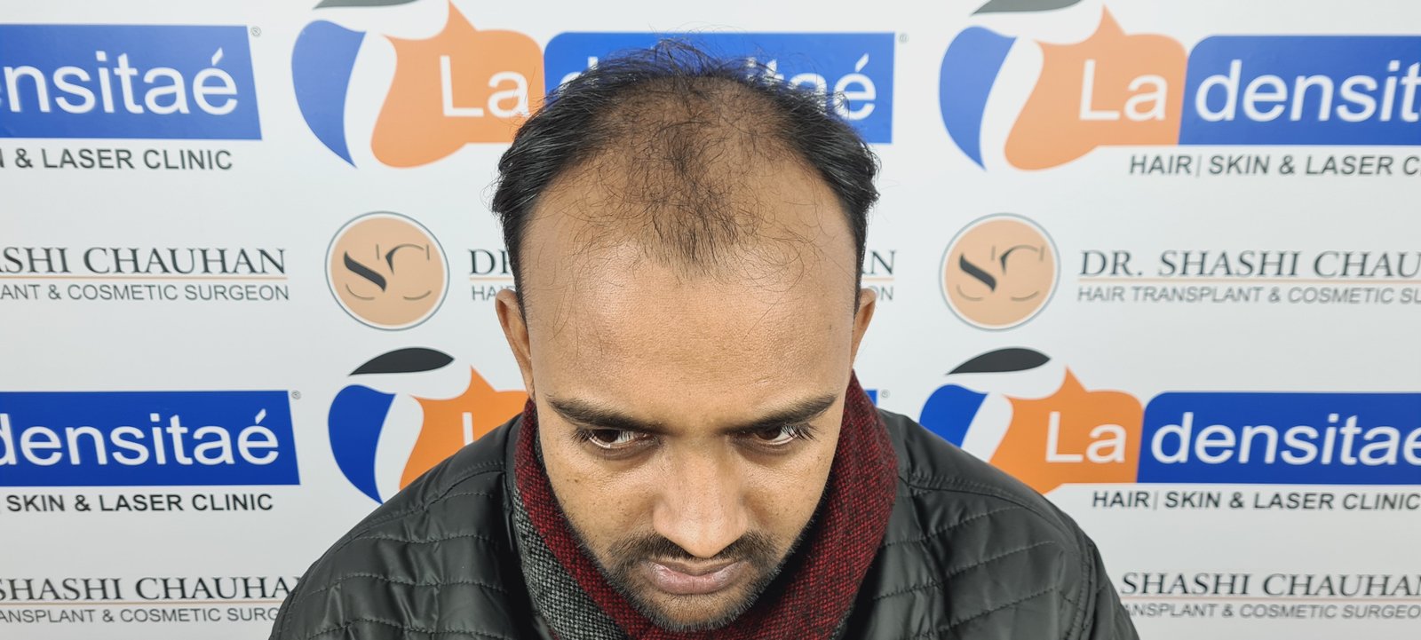Abhay Pratap Yadav Before Hair Transplant